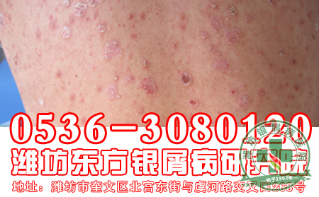 关于牛皮癣的治疗问题了解-济南皮肤病医院