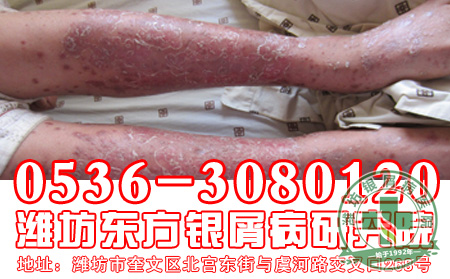 关于牛皮癣的治疗问题了解-济南皮肤病医院