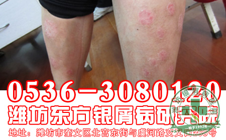 预防牛皮癣也要从生活中做起-济南牛皮癣医院