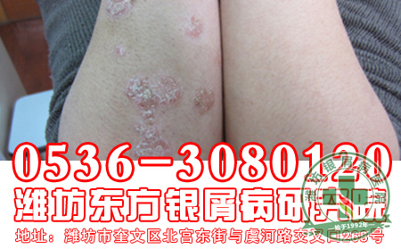 预防牛皮癣也要从生活中做起-济南牛皮癣医院