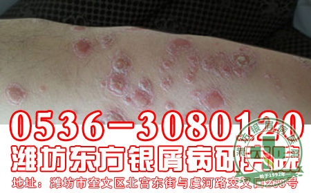 牛皮癣患者可以不要化妆-济南银屑病专科医院