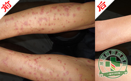牛皮癣患者可以不要化妆-济南银屑病专科医院