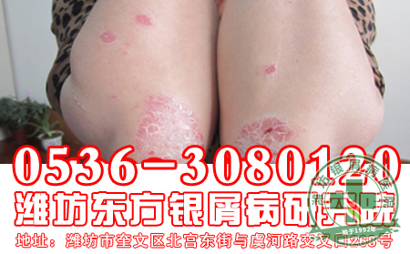 牛皮癣在初期能不能 -山东银屑病医院