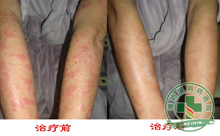 牛皮癣与感冒关系密切吗-济南牛皮癣医院