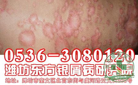 牛皮癣用药时有什么禁忌-济南皮肤病医院