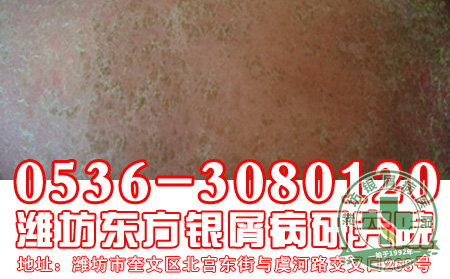 牛皮癣用药时有什么禁忌-济南皮肤病医院