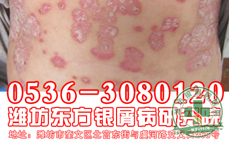 治疗牛皮癣一般都有什么方法-济南银屑病专科医院