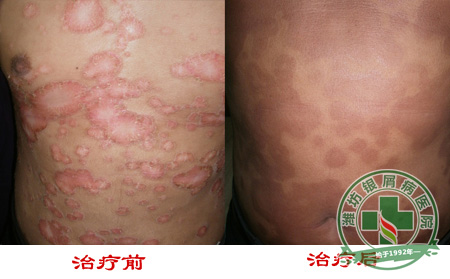 可以心态减少牛皮癣复发-济南皮肤病医院