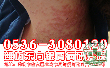 牛皮癣的预防措施都有什么-山东银屑病医院