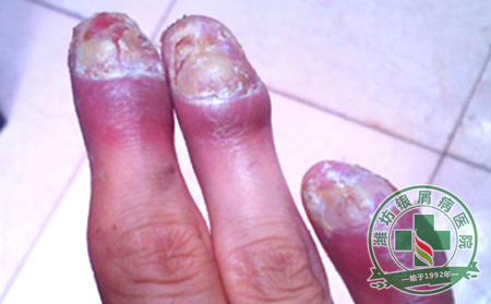 为什么牛皮癣总是易复发-山东银屑病医院