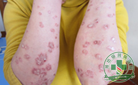 为什么牛皮癣总是易复发-山东银屑病医院