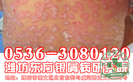 牛皮癣患者要理性看待宣传广告-济南皮肤病医院