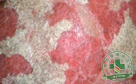 外伤对牛皮癣的影响大不大-济南牛皮癣医院