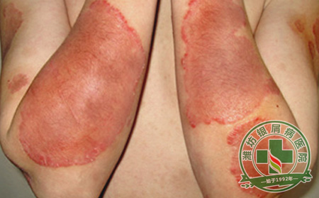 外伤对牛皮癣的影响大不大-济南牛皮癣医院