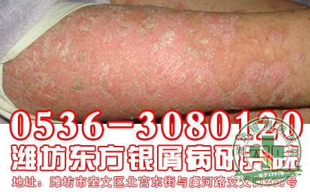 牛皮癣到底可不可祛除啊-济南银屑病专科医院