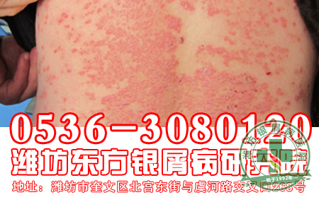 牛皮癣用药都有什么要注意的-山东银屑病医院