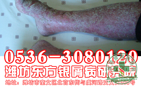 牛皮癣治疗都有哪些原则要遵循-济南皮肤病医院