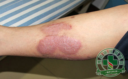 牛皮癣常识