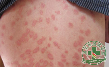 银屑病患者夏季必须注意的几点
