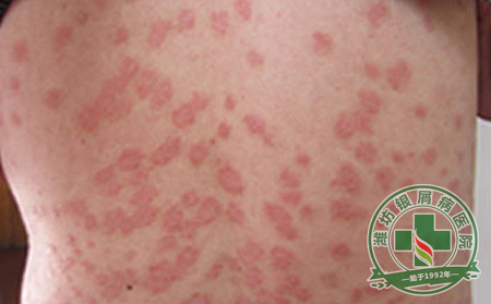银屑病患者夏季必须注意的几点