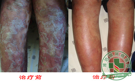 SP-R绿色净肤疗法——寻常型银屑病治疗