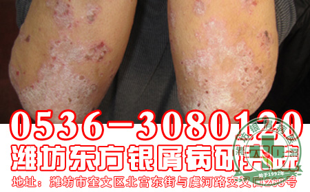 多年的银屑病了