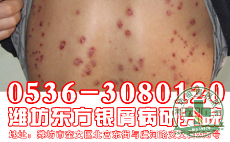 银屑病症状需要注意哪些?