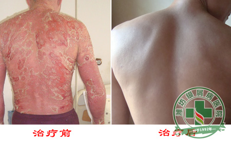 女性银屑病日常生活中应该怎样护理?