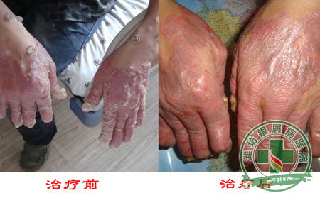 女性银屑病日常生活中应该怎样护理?