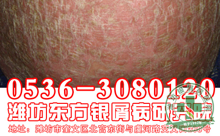 银屑病发病诱因有哪些?