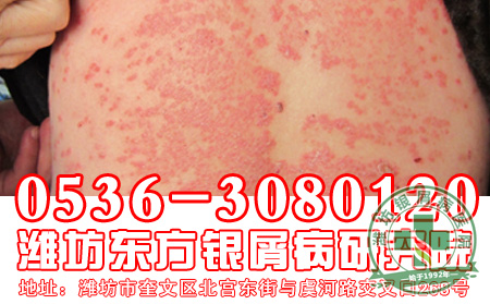 头部银屑病洗头注意事项