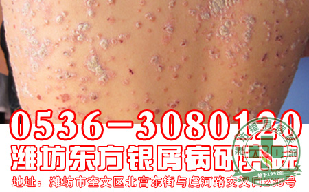 银屑病生活该注意哪些?