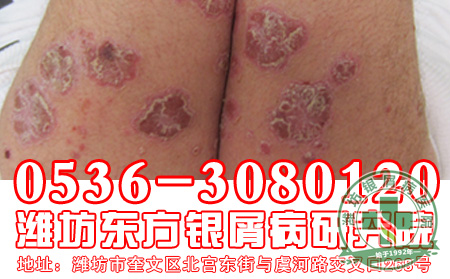 银屑病在生活中给患者造成的影响？