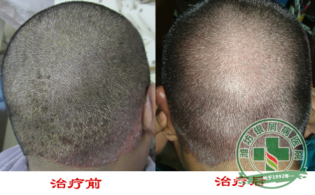 一定要正确看待女性银屑病患者
