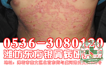 一般银屑病皮损会蔓延吗？