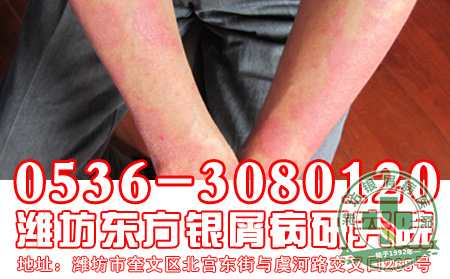 银屑病造成的危害有哪些?