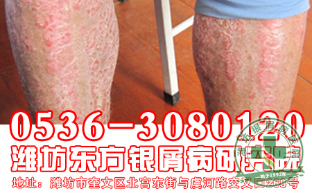 防止银屑病扩散的措施