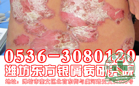 银屑病的分型治疗给患者带来了希望