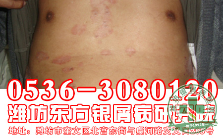 分析银屑病与气候之间的联系