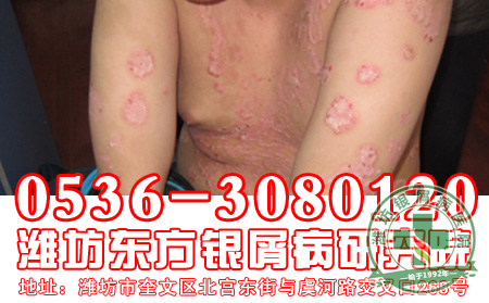 大医大爱，治天下银屑病