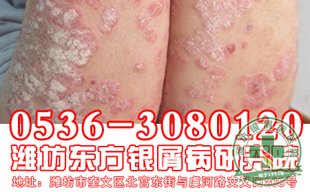 银屑病患者洗澡有哪些需注意