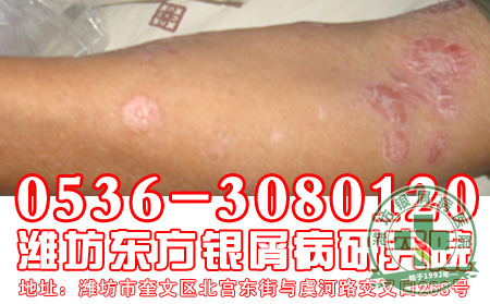 常见的银屑病食疗方法
