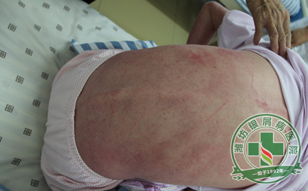 银屑病患者选择哪里治疗可以呢