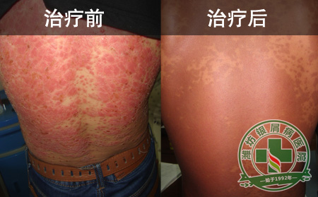 银屑病治疗