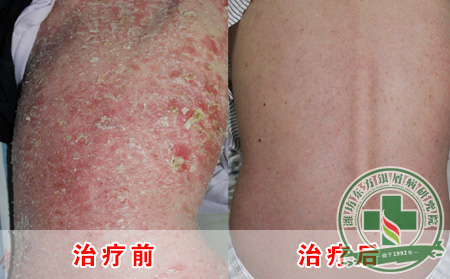 银屑病局部给药治疗