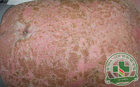 银屑病和牛皮癣有区别吗?