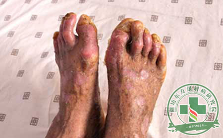 银屑病常识
