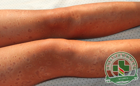 牛皮癣的正规医学名称是什么