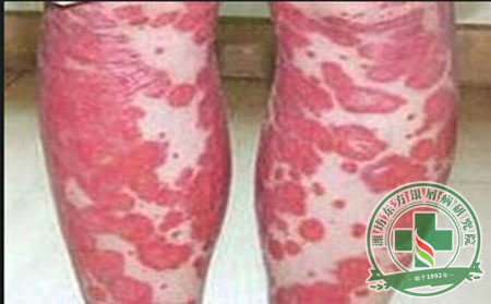 银屑病发病有规可循