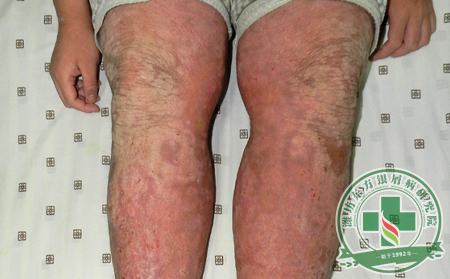 要治疗牛皮癣患者必须找到可行性方案